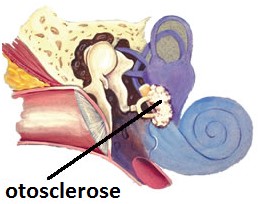 otosclerose