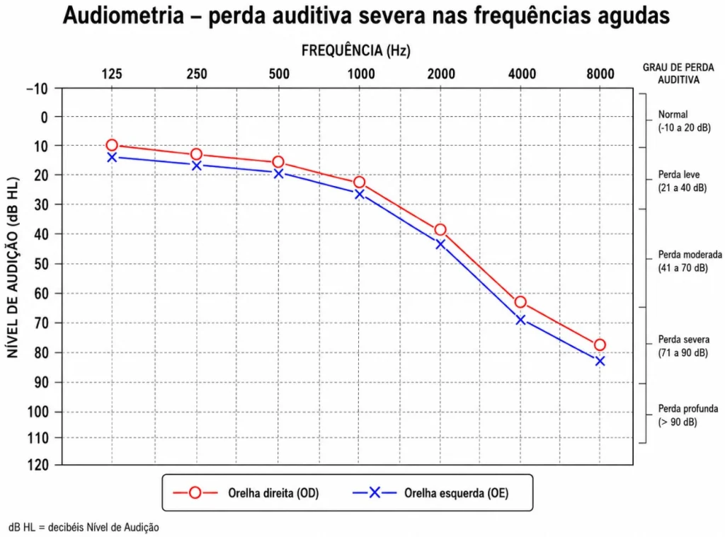 Entenda o impacto da SURDEZ EM AGUDOS audiometria surdez em agudos